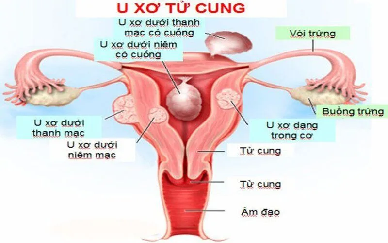 u xo tu cung la gi nguyen nhan dau hieu nhan biet som va cach xu ly