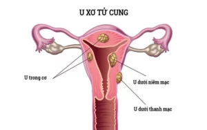 U xơ tử cung là gì? Nguyên nhân, dấu hiệu nhận biết sớm và cách xử lý 
