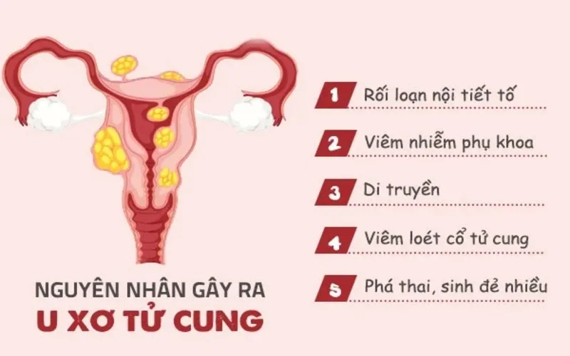 u xo tu cung la gi nguyen nhan trieu chung va cach dieu tri