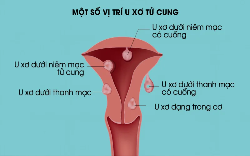 u xo tu cung la gi nguyen nhan trieu chung va cach dieu tri