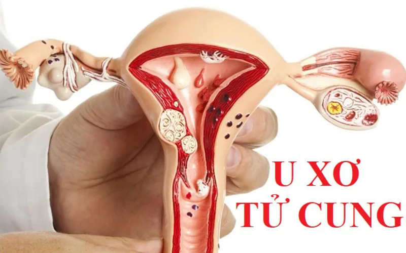 u xo tu cung la gi nguyen nhan trieu chung va cach dieu tri