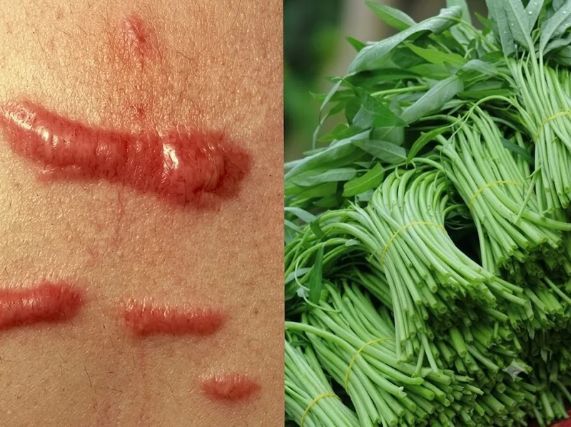 Chưa có bằng chứng chắc chắn rằng ăn rau muống trực tiếp gây sẹo lồi.